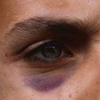 bruise